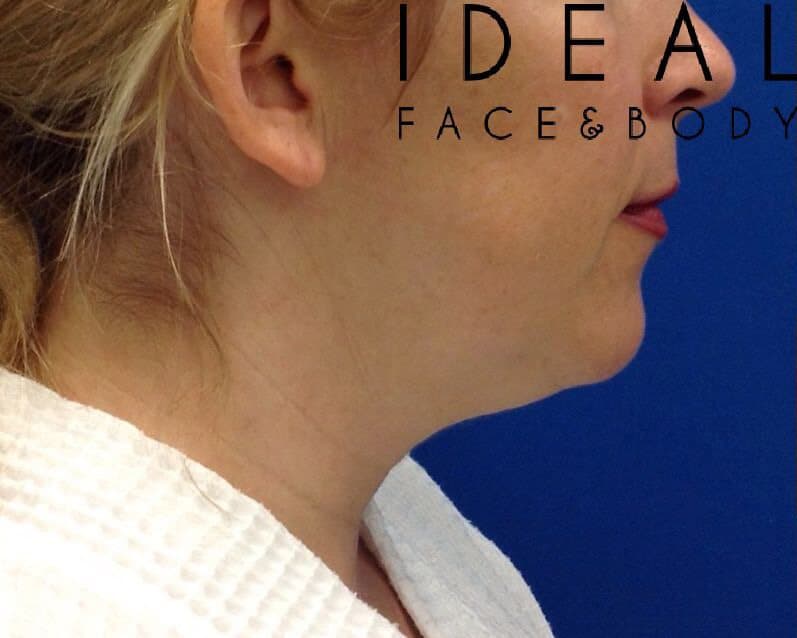 Before Image: Awake Chin, Neck, & Jawline Liposculpting | PRECISION SCULPT® - right-side