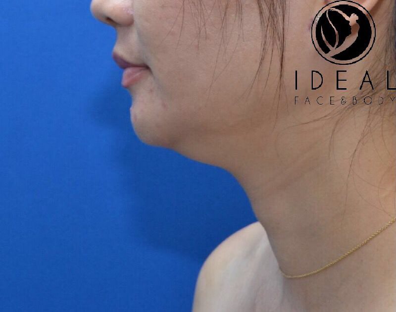 Before Image: Awake Chin, Neck, & Jawline Liposculpting | PRECISION SCULPT® - left-side