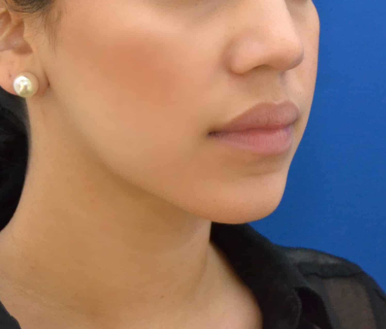 After Image: Chin, Neck, & Jawline | Awake Liposculpting | PRECISION SCULPT® - right-front-oblique