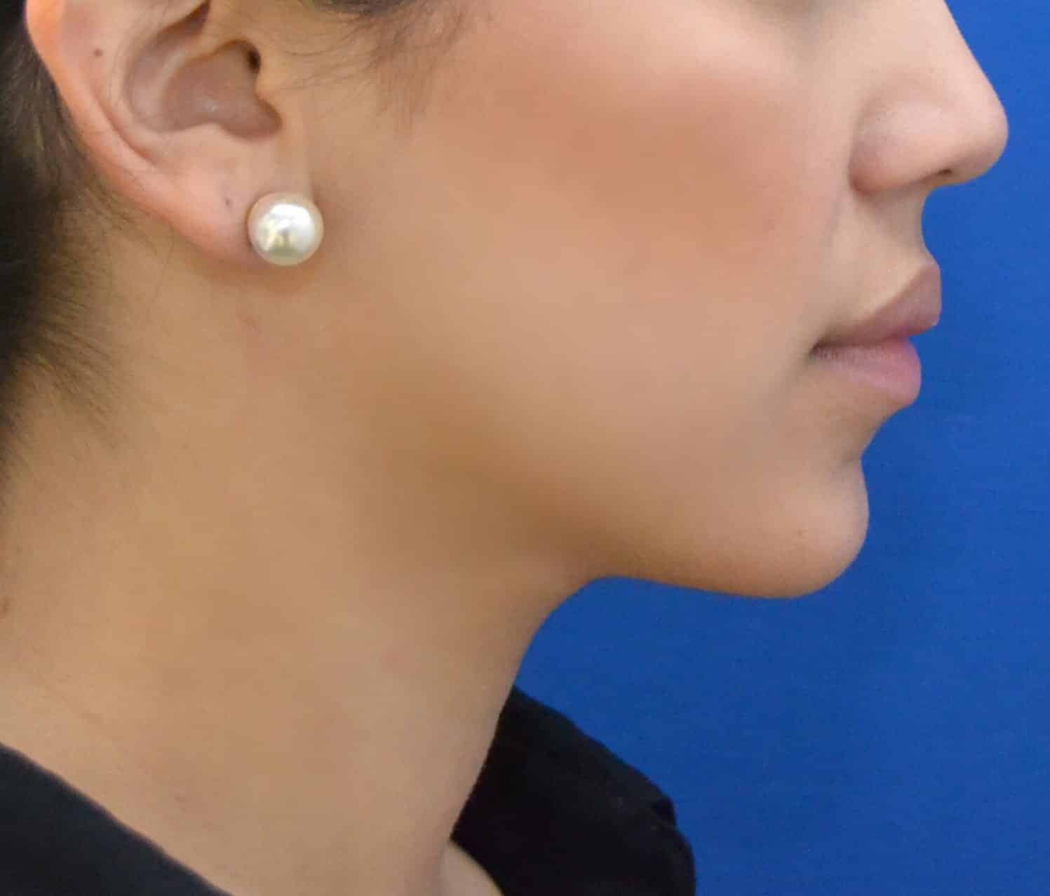 After Image: Chin, Neck, & Jawline | Awake Liposculpting | PRECISION SCULPT® - right-side