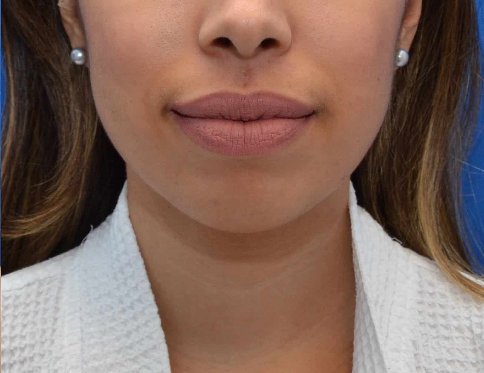 After Image: Awake Liposculpting Chin, Neck, Jawline | PRECISION SCULPT® - front