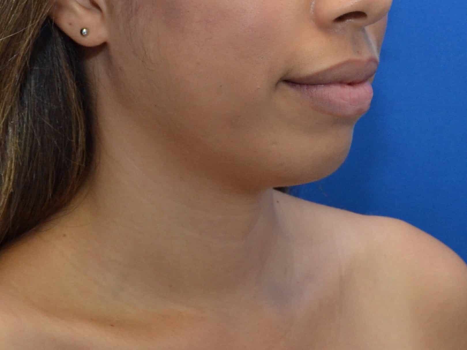 Before Image: Awake Liposculpting Chin, Neck, Jawline | PRECISION SCULPT® - right-front-oblique