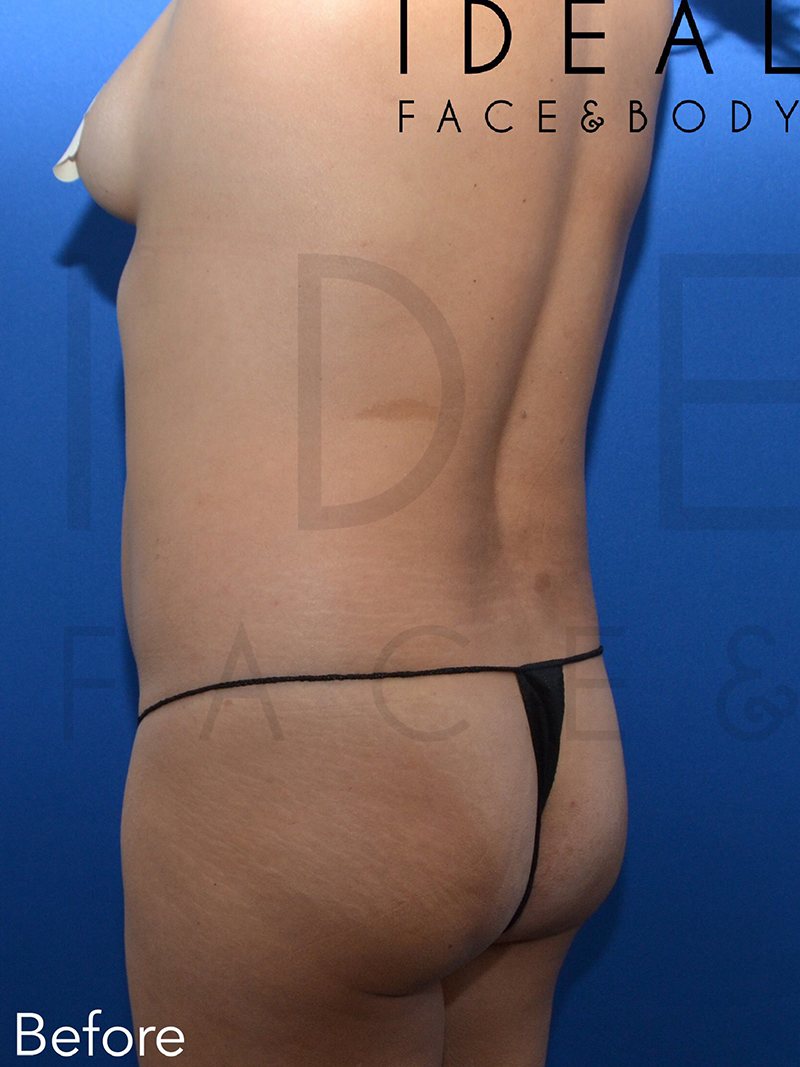 Before Image: Stomach / Waist - left-back-oblique