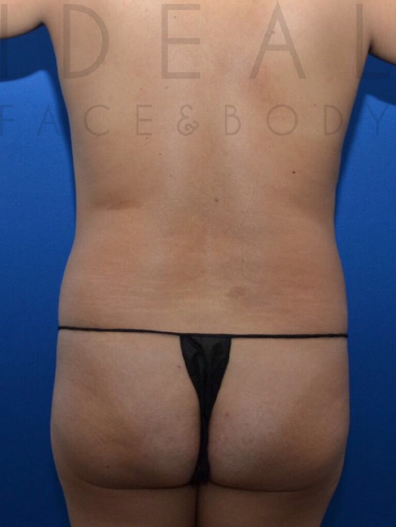 Before Image: Stomach / Waist - back