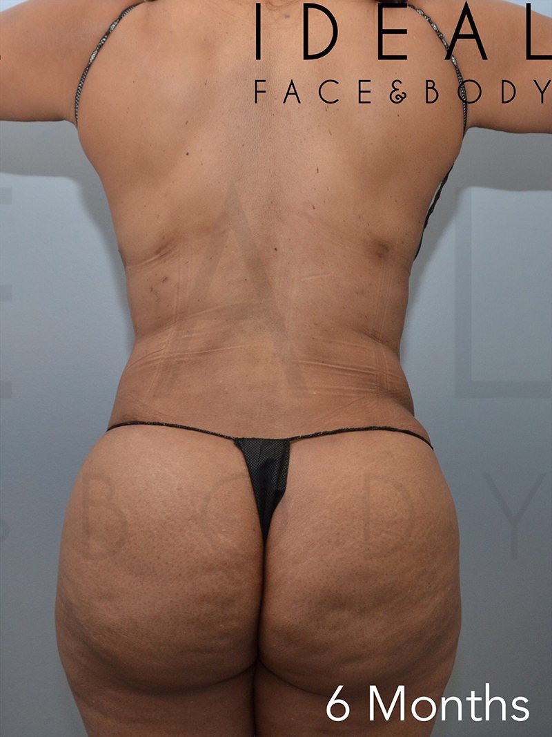 After Image: Stomach / Waist - back