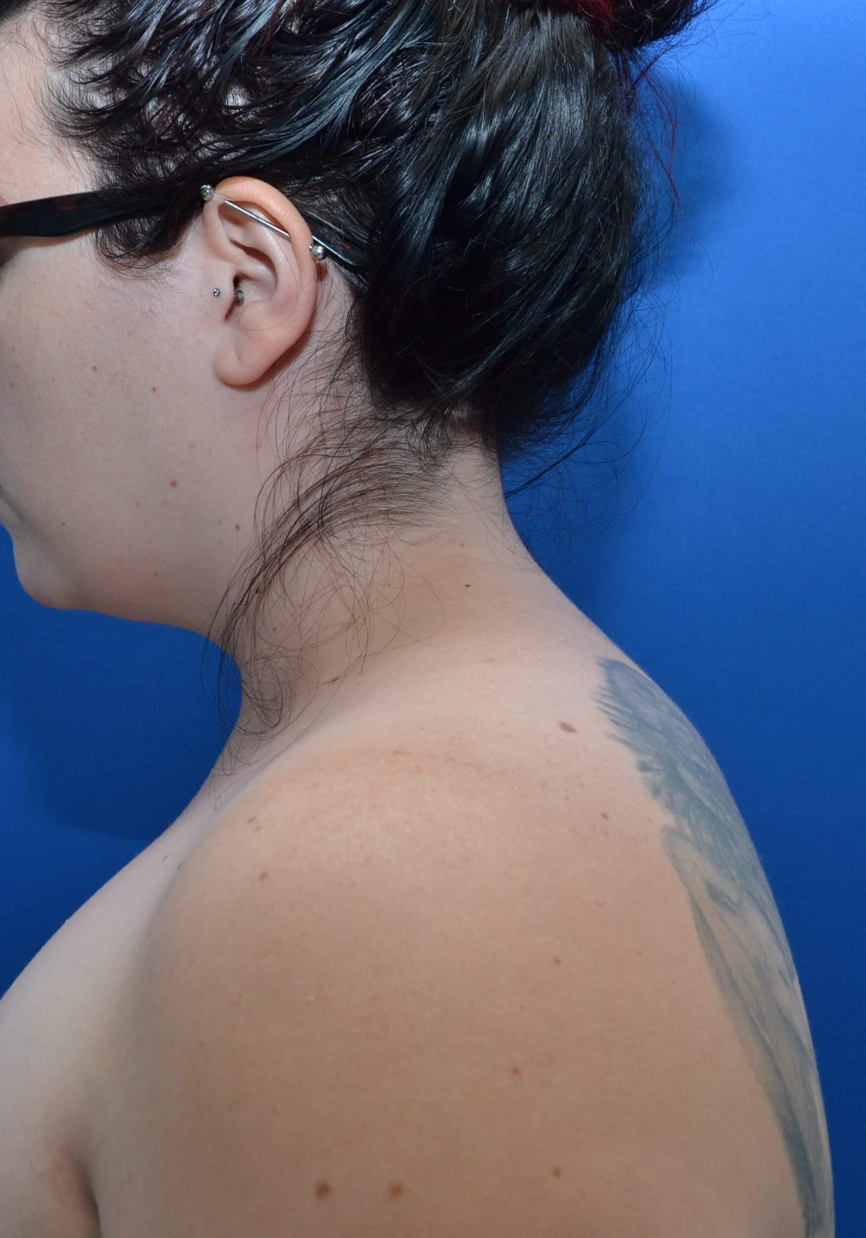 After Image: Awake Buffalo Hump Removal | PRECISION SCULPT® - left-side