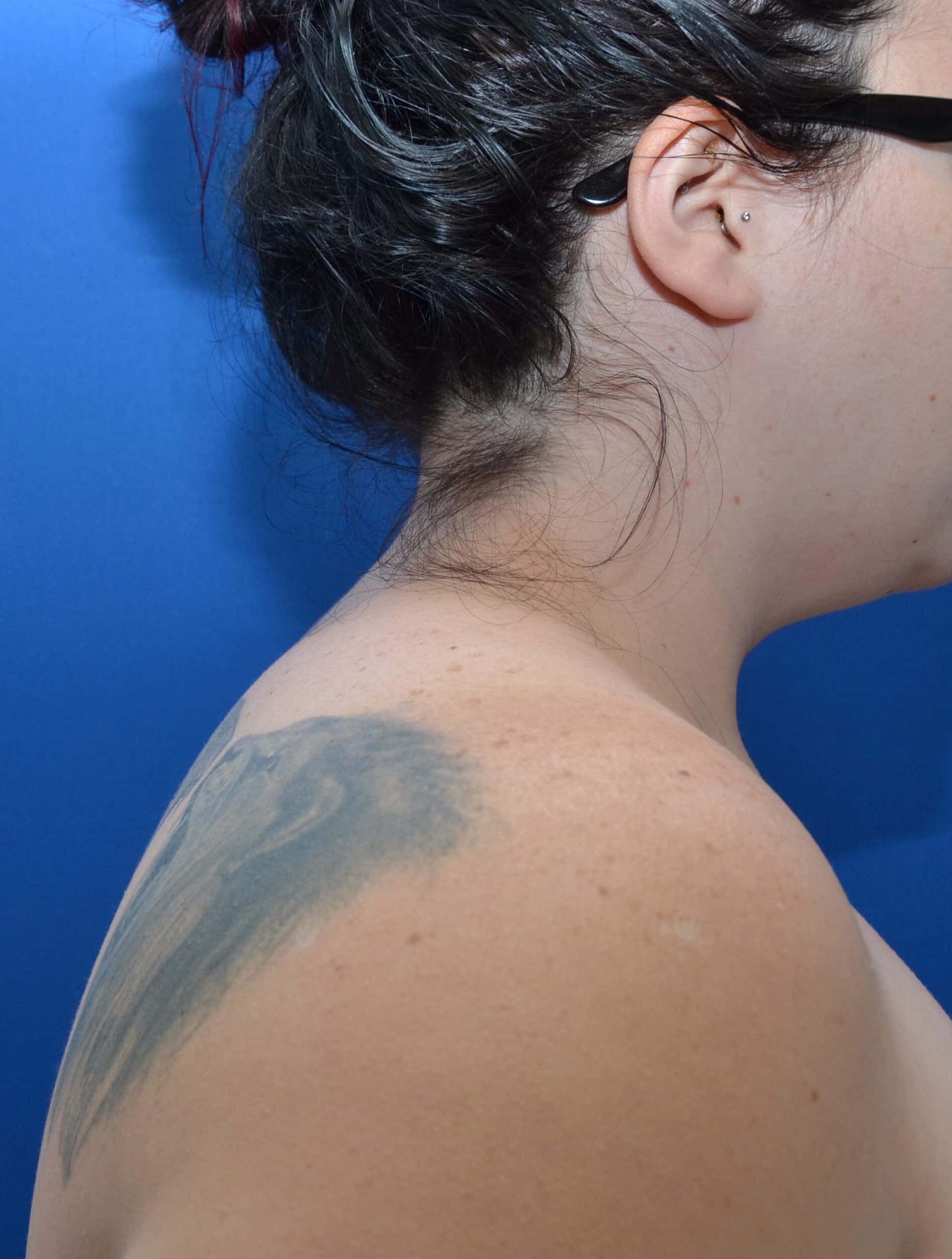 After Image: Awake Buffalo Hump Removal | PRECISION SCULPT® - right-side