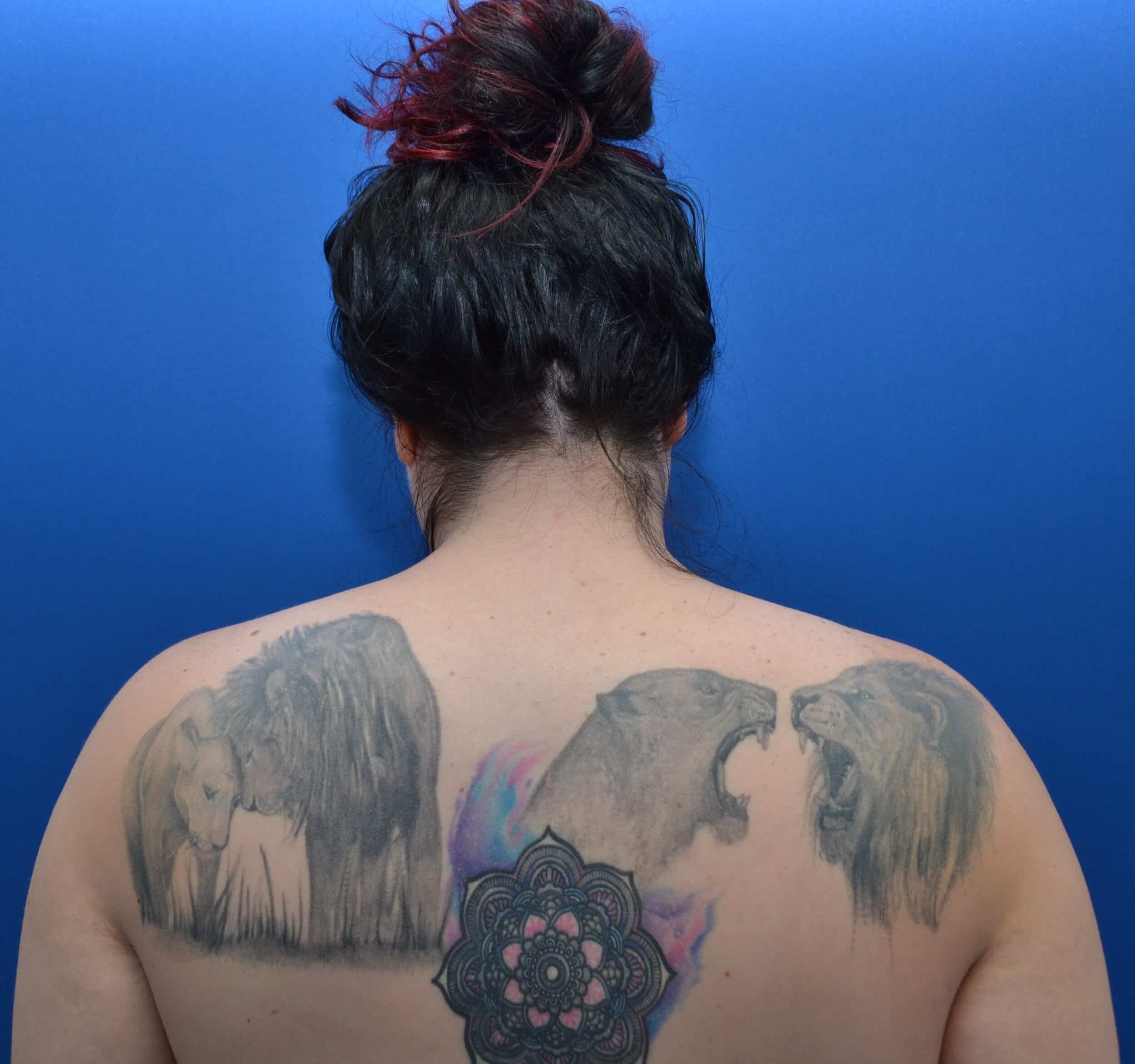 After Image: Awake Buffalo Hump Removal | PRECISION SCULPT® - back