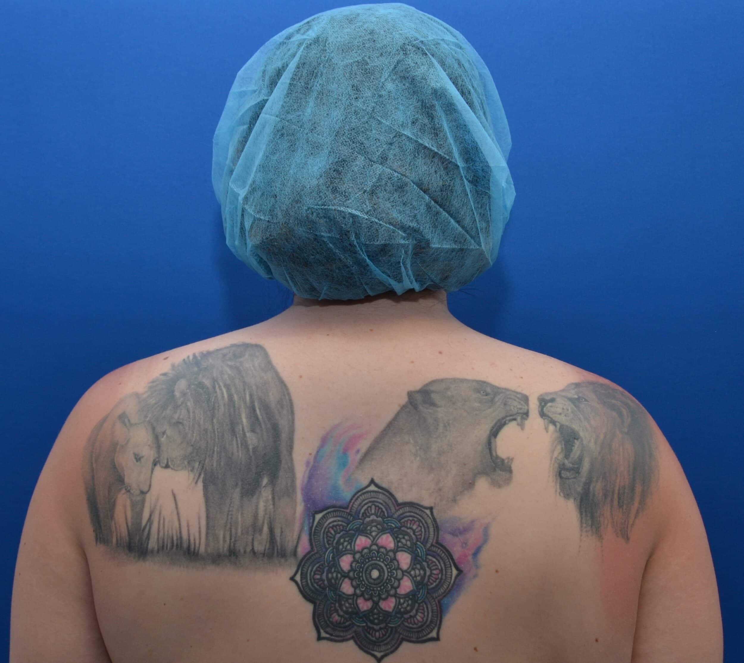 Before Image: Awake Buffalo Hump Removal | PRECISION SCULPT® - back