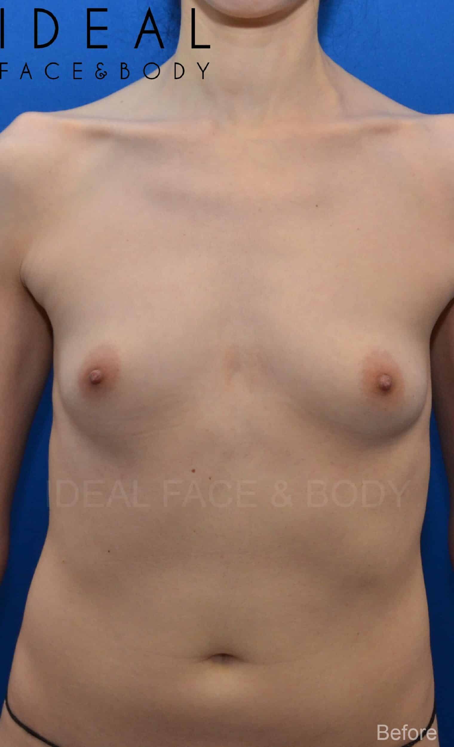 Before Image: Awake Breast Fat Transfer | Raise Your Cup® - front