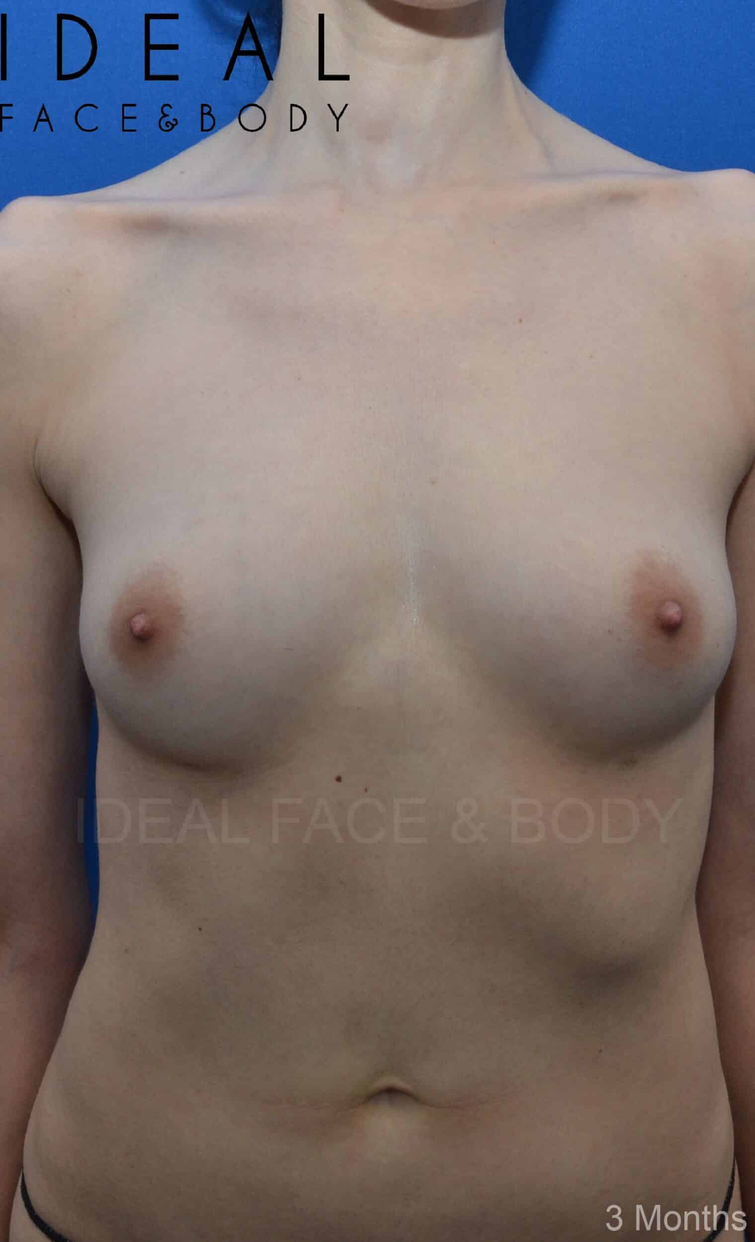 After Image: Awake Breast Fat Transfer | Raise Your Cup® - front