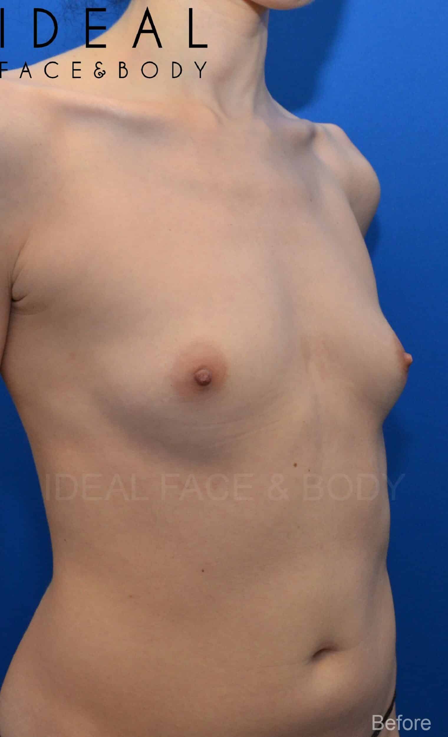 Before Image: Awake Breast Fat Transfer | Raise Your Cup® - right-front-oblique