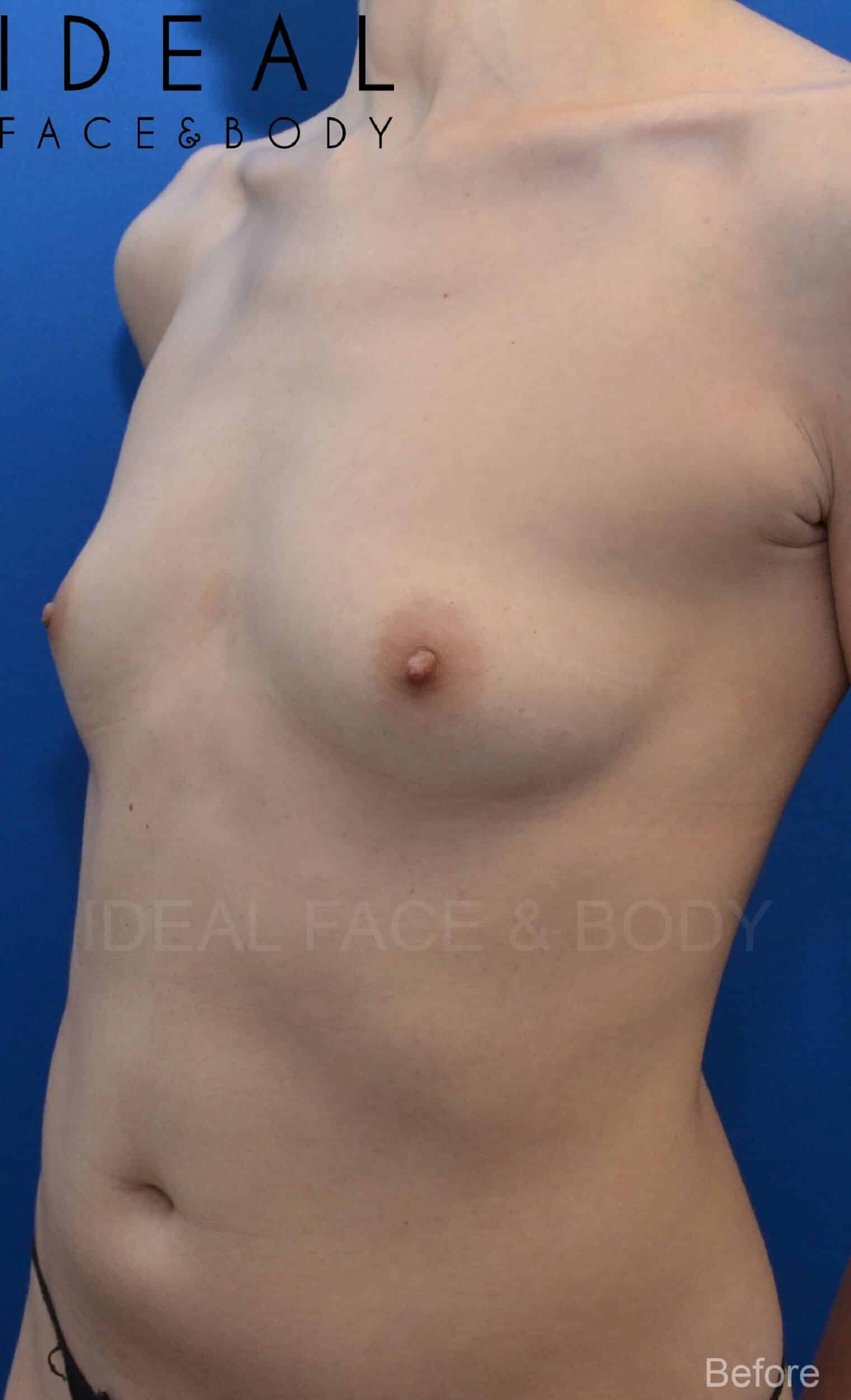 Before Image: Awake Breast Fat Transfer | Raise Your Cup® - left-front-oblique