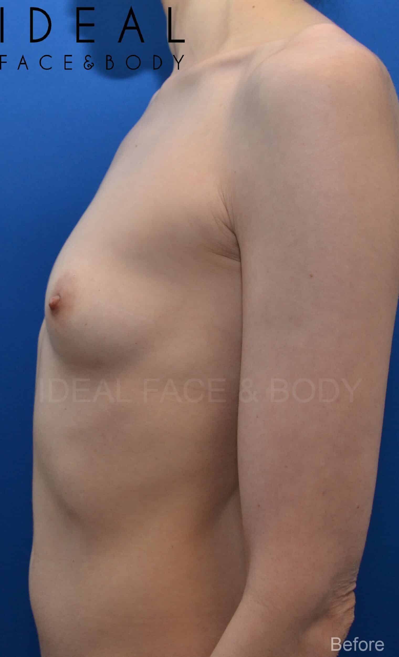 Before Image: Awake Breast Fat Transfer | Raise Your Cup® - left-side