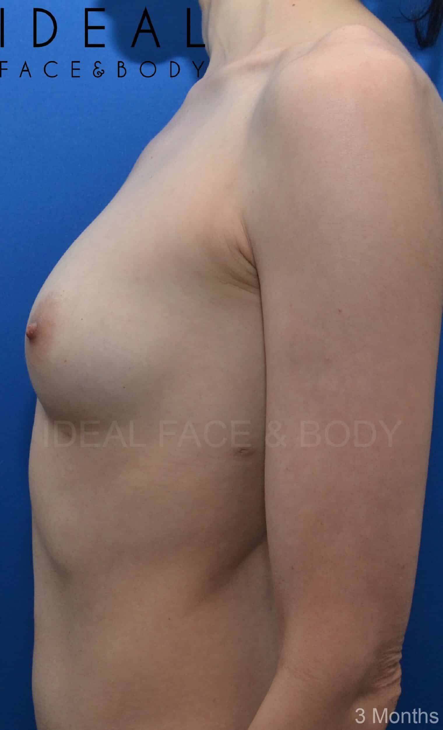 After Image: Awake Breast Fat Transfer | Raise Your Cup® - left-side