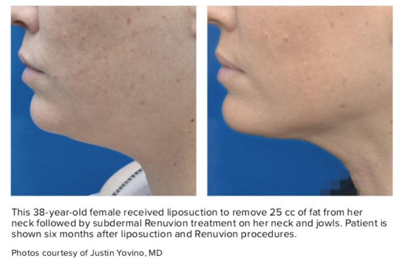 liposuction, Achieve Dynamic Results with Liposuction and Renuvion
