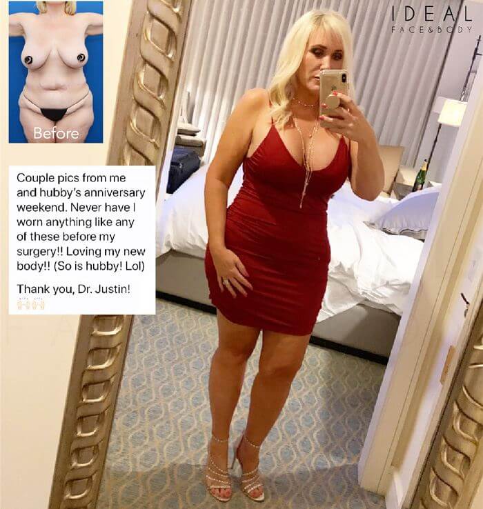 A patient who underwent Precision Sculpt® poses in a red dress. Her "before" image is superimposed in the upper corner of the image for comparison, demonstrating her newly slimmed figure. Also superimposed is commentary from the patient. Text reads: "COUPLE PICS FROM ME AND HUBBY'S ANNIVERSARY WEEKEND. NEVER HAVE I WORN ANYTHING LIKE ANY OF THESE BEFORE MY SURGERY!! LOVING MY NEW BODY! SO IS HUBBY! LOL. THANK YOU DR. JUSTIN!"