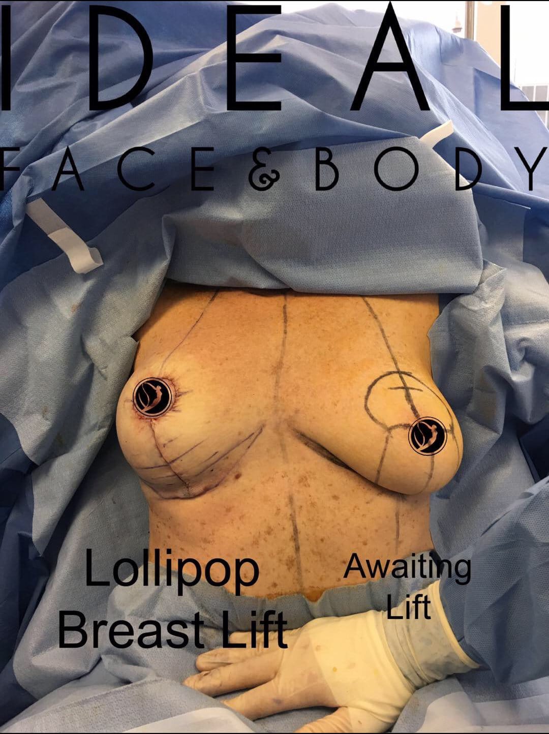 Showcase on breast lift page