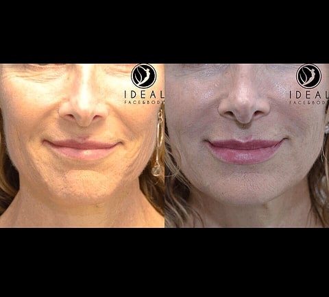 skin injectables example