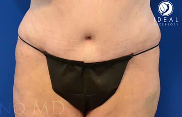 tummytuck p3 frontb a