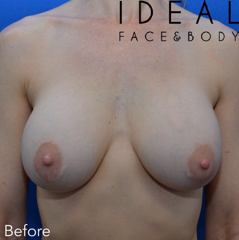 Breast Implant Removal (Awake)