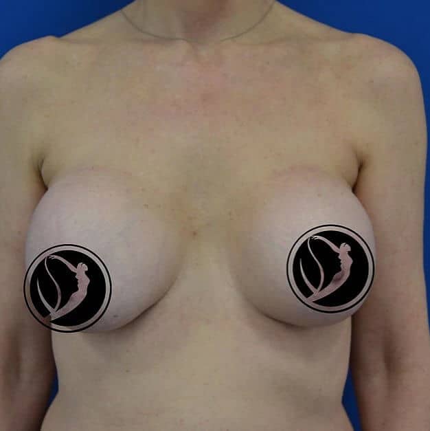 Breast Implant Revision