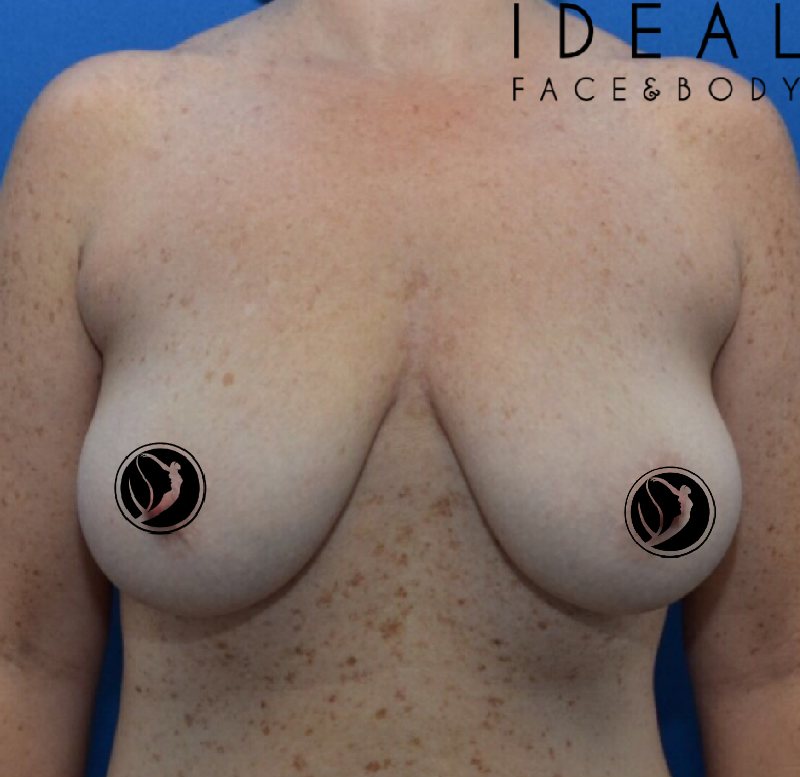 Awake Breast Lift ® / Mastopexy