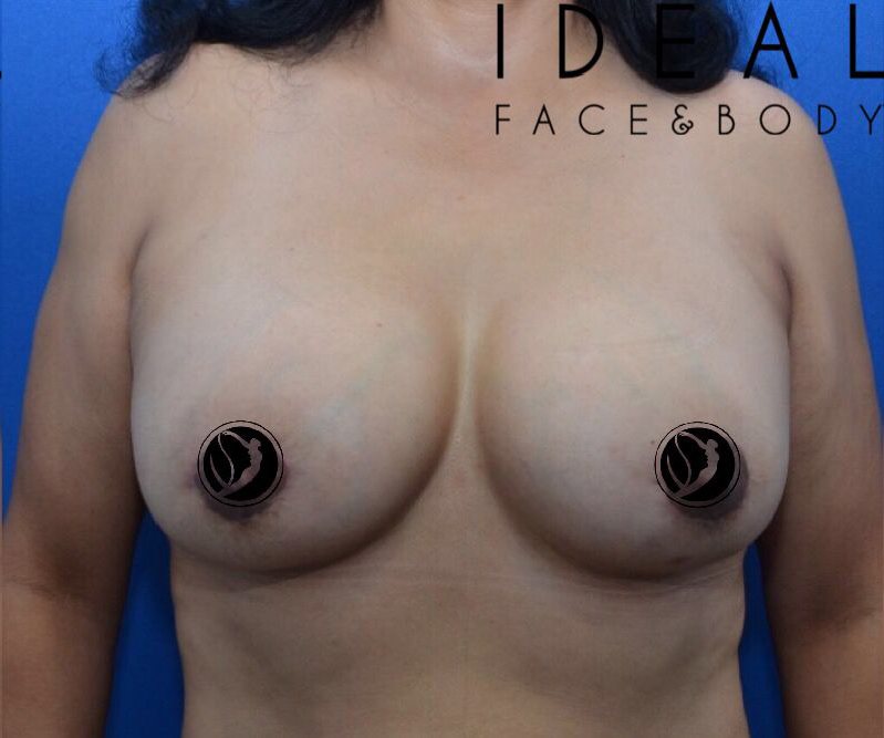 Breast Lift & Implants