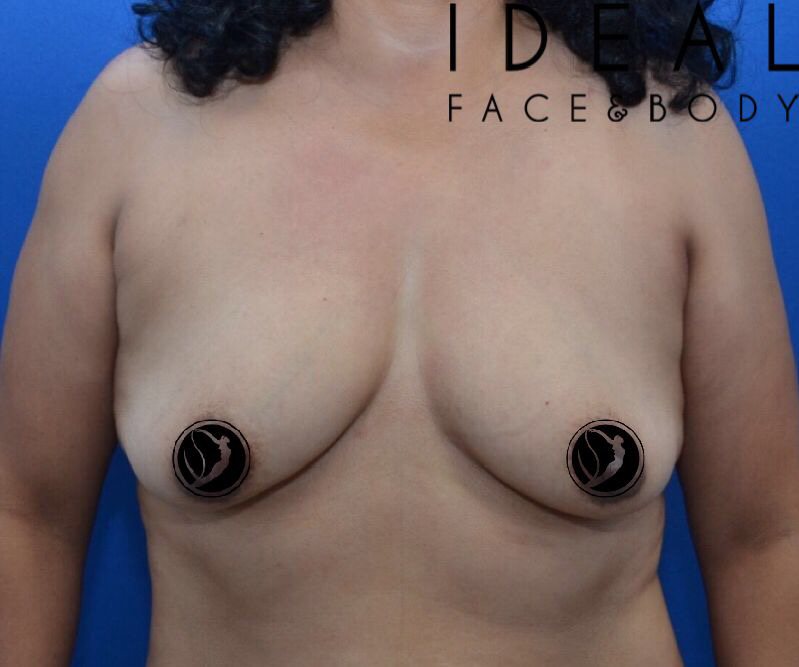 Breast Lift & Implants