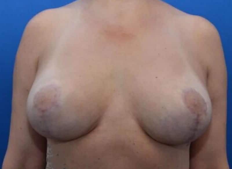 Breast Lift / Breast Reduction