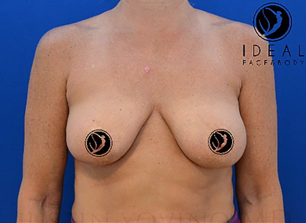 Breast Lift / Mastopexy