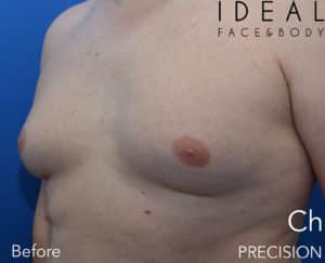 Awake Male Breast Reduction / Gynecomastia Surgery