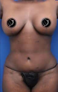 Mommy Makeover / Breast Augmentation & Lift / Tummy Tuck / Abdominoplasty