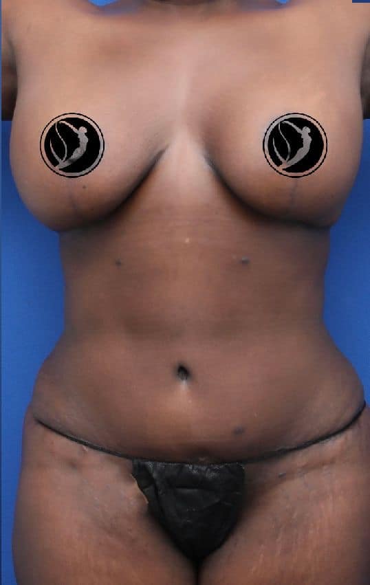 Mommy Makeover / Breast Augmentation & Lift / Tummy Tuck / Abdominoplasty