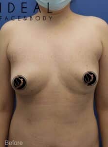 Breast Fat Transfer After Explant
