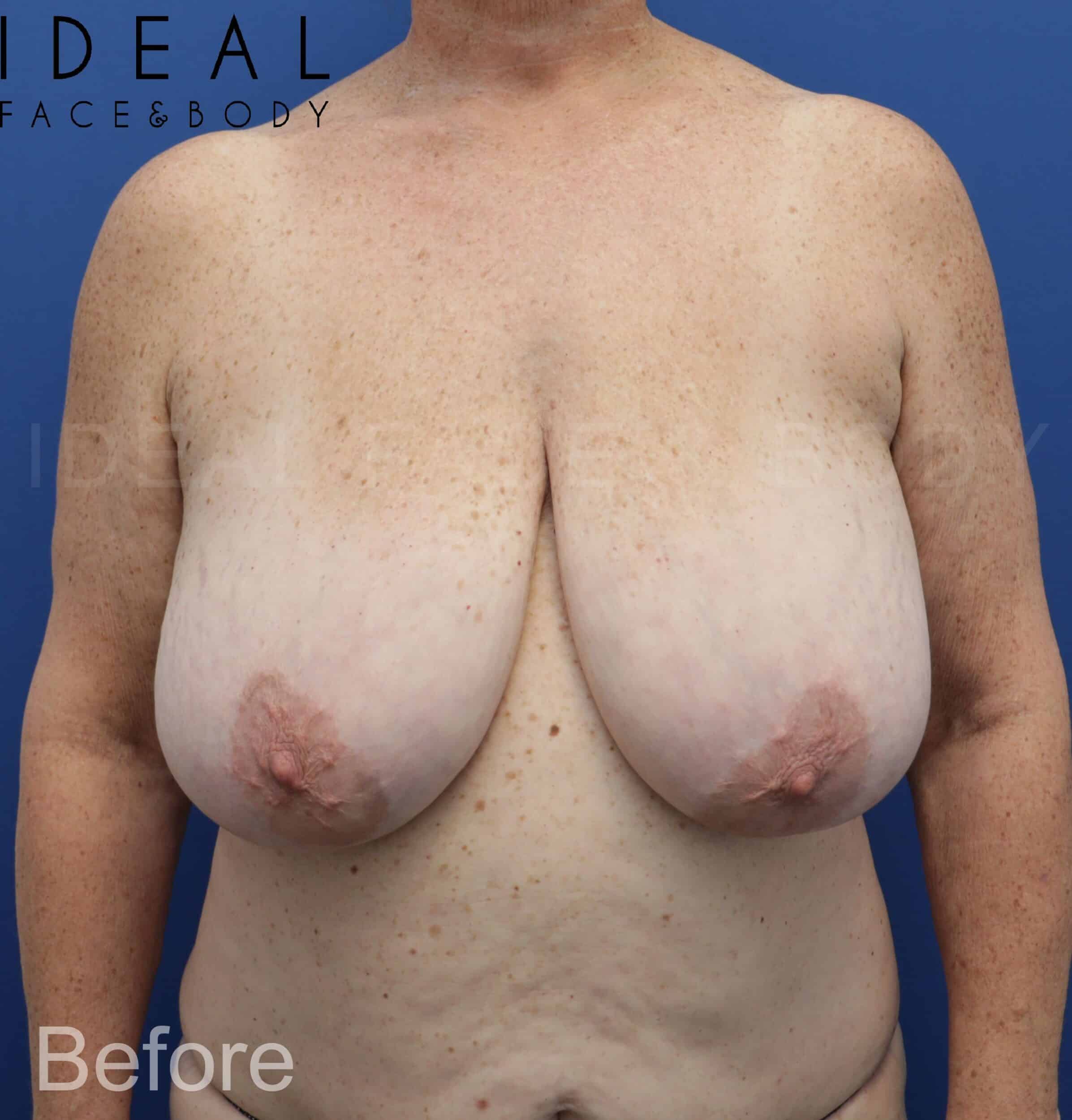 Awake Breast Reduction ™