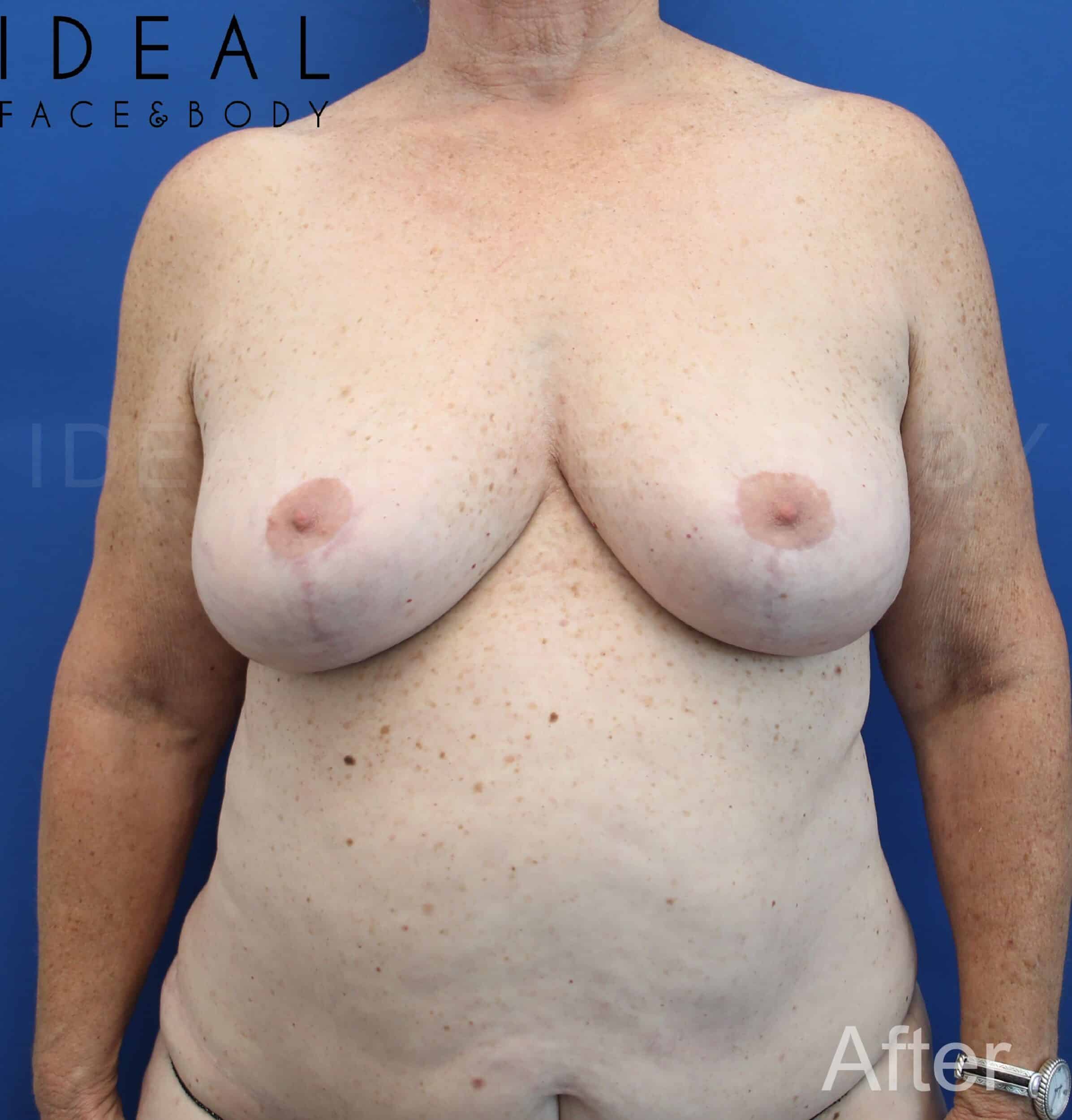 Awake Breast Reduction ™