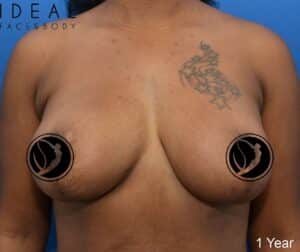 Breast Augmentation & Lift / Augmentation Mastopexy