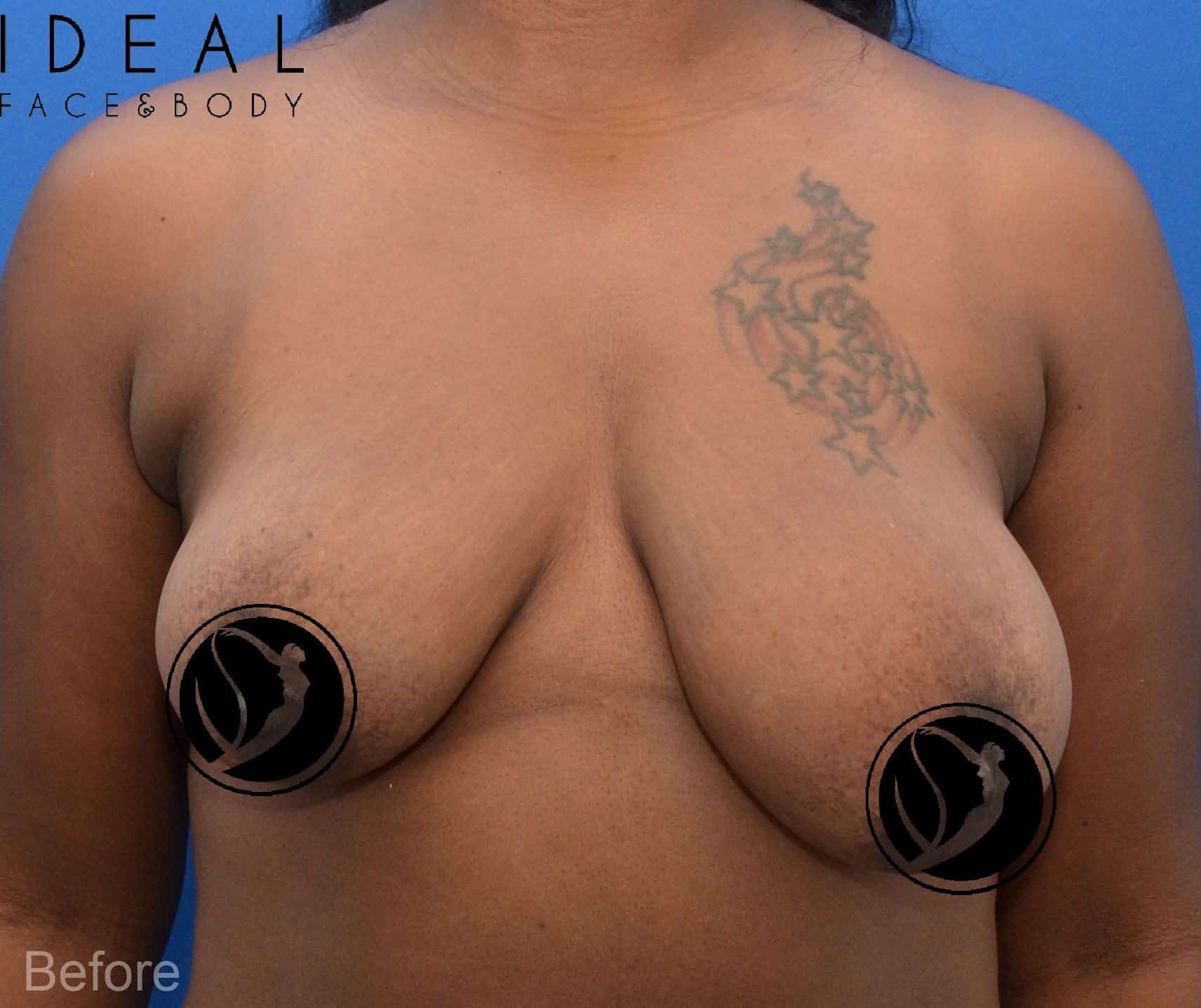 Breast Augmentation & Lift / Augmentation Mastopexy