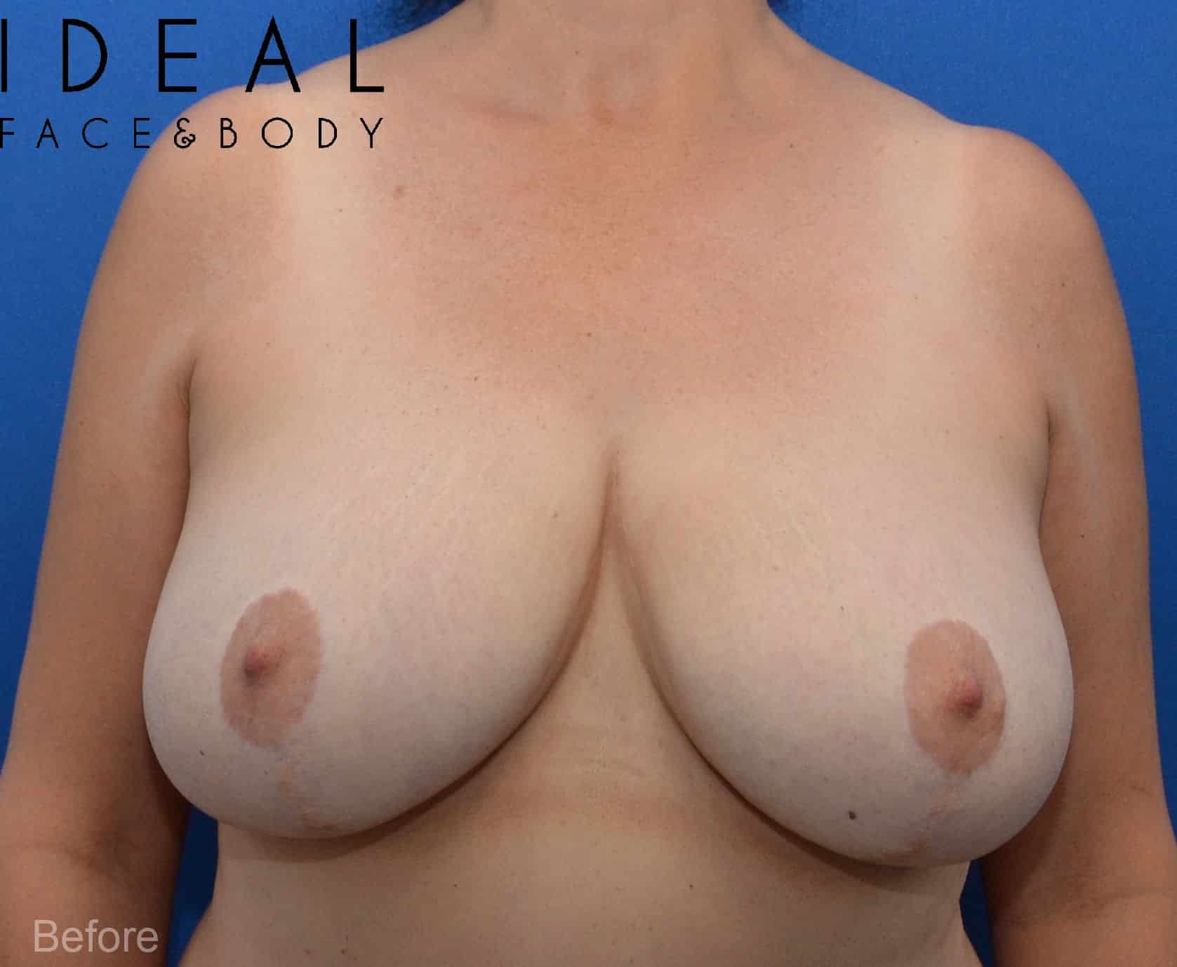 Liposuction-Only Breast Reduction