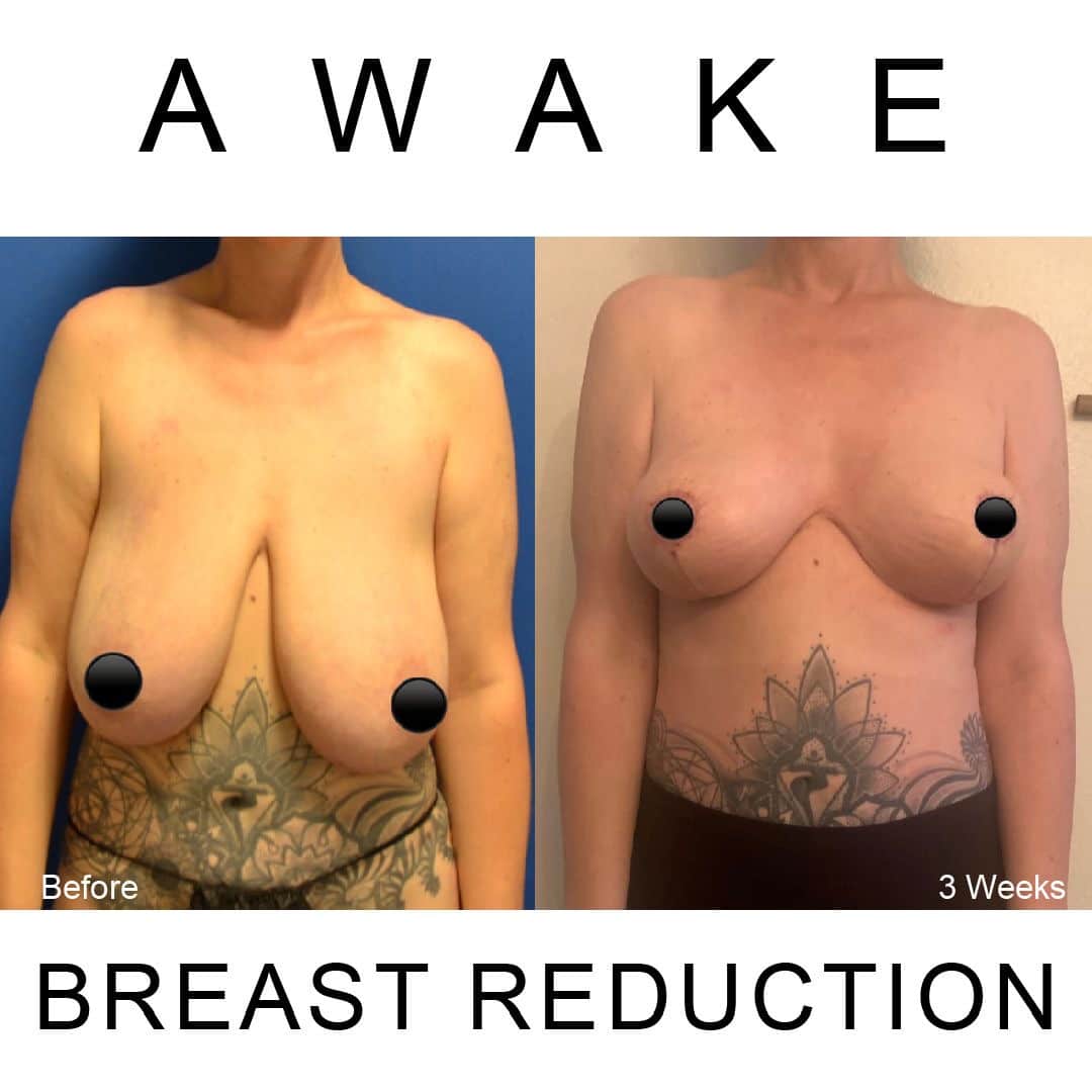 Before and After Awake Breast Reduction ℠