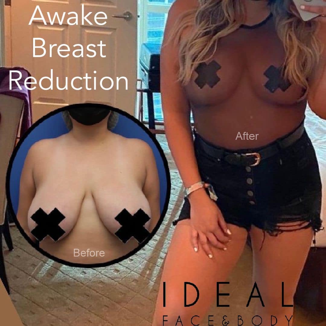 Before and after awake breast reduction