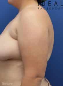 Arm Liposuction / PRECISION SCULPT ®