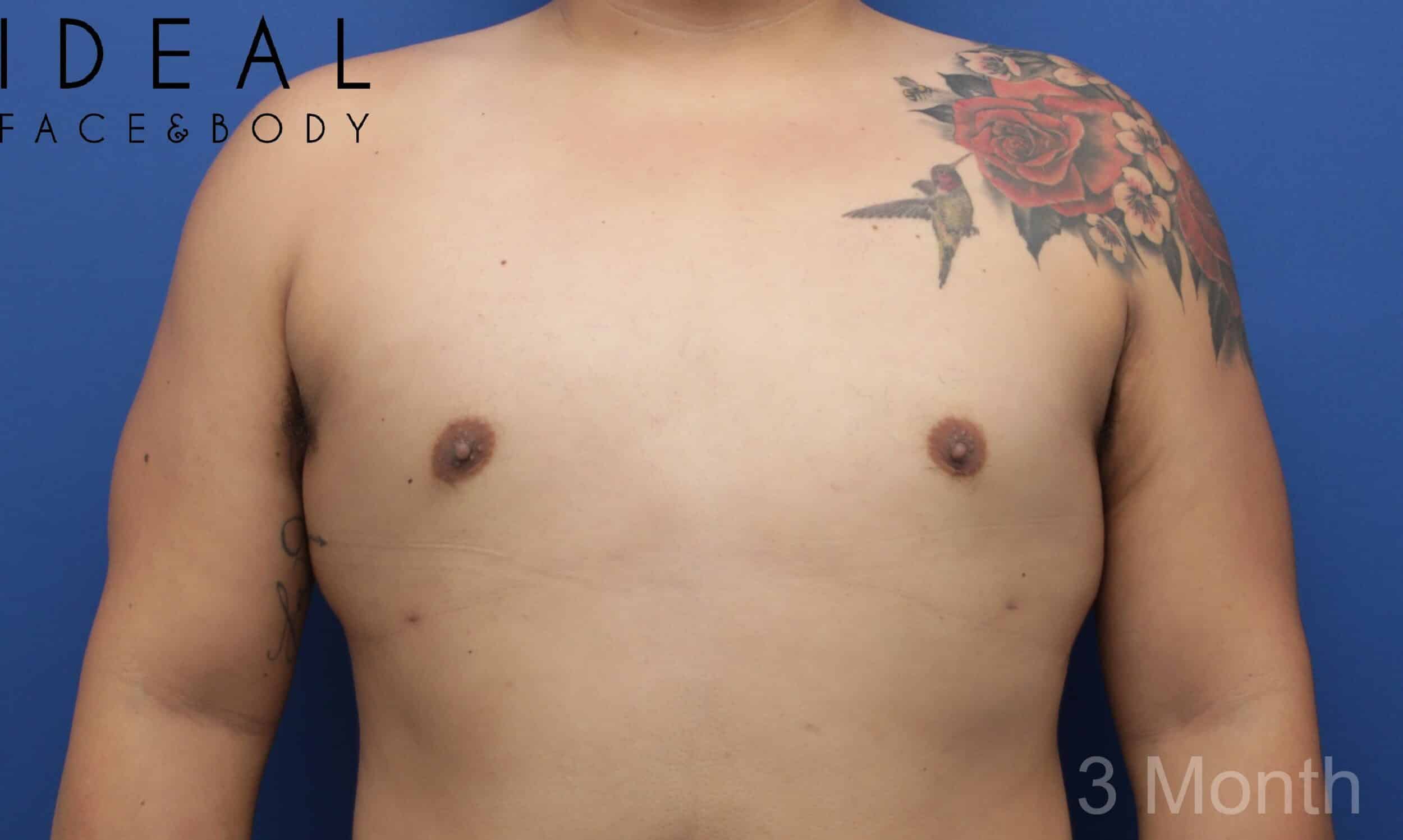Awake Male Chest Liposuction / Gynecomastia Surgery
