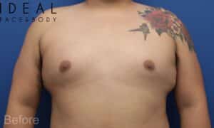Awake Male Chest Liposuction / Gynecomastia Surgery
