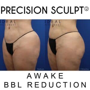 Before and after bbl fat transfer to the buttocks reduction