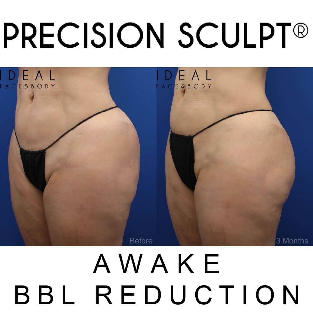 BBL Reduction / Revision - Ideal Face and Body