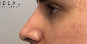 Nose Reshaping Non-surgical Rhinoplasty