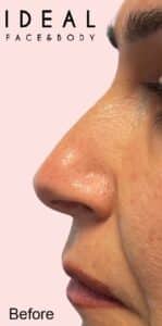 Nose Reshaping Non-Surgical Rhinoplasty