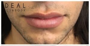Male Lip Augmentation | Painless